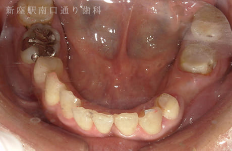 左下にフルジルコニアブリッジ術前