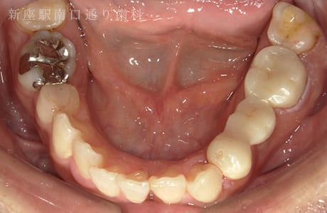 左下にフルジルコニアブリッジ術後