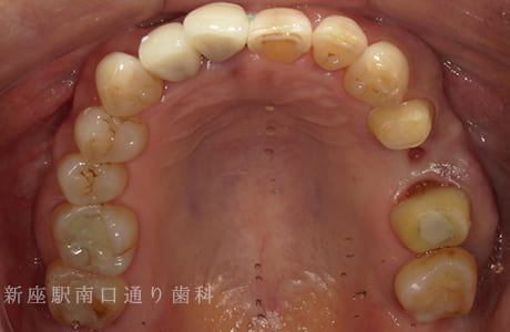 左上にフルジルコニアブリッジ術前