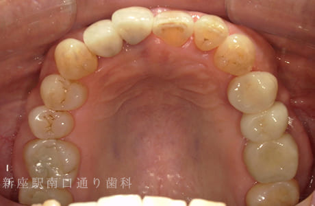 左上にフルジルコニアブリッジ術前