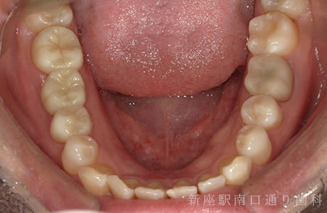 右下にフルジルコニアブリッジで修復