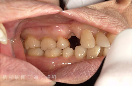 右上にフルジルコニアブリッジで修復術前