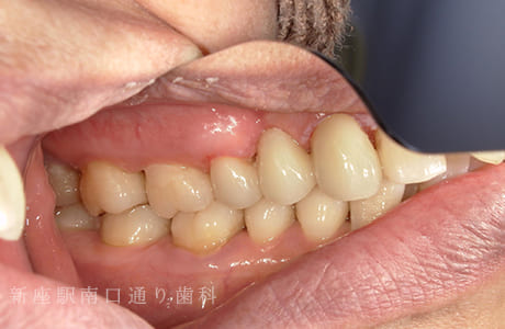 右上にフルジルコニアブリッジで修復術後