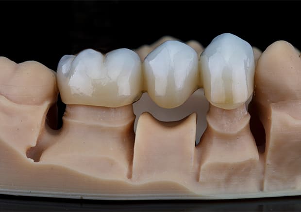 ブリッジ治療とは？