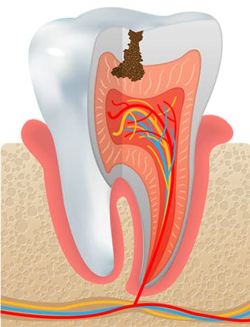 虫歯の中期 C2（歯の中の象牙質の虫歯）