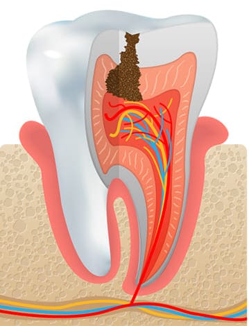 虫歯の後期 C3（神経まで進行した虫歯）