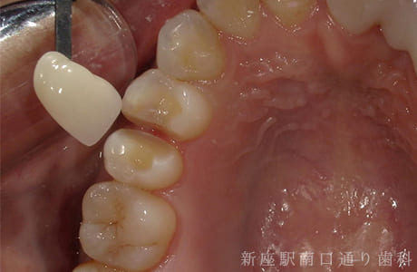 上顎術前セラミックe-maxインレー術前