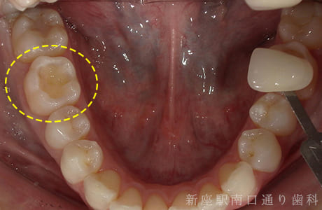 下顎術前セラミックe-maxインレー術前