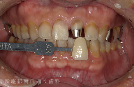 ジルコボンドの術中