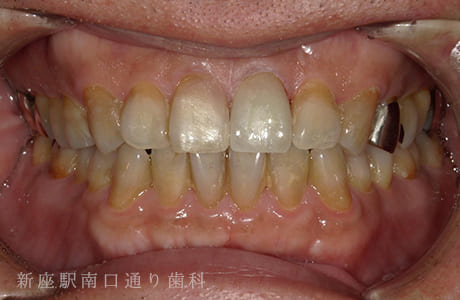 ジルコボンドの術後