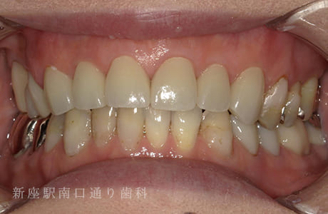 ジルコボンドの術後