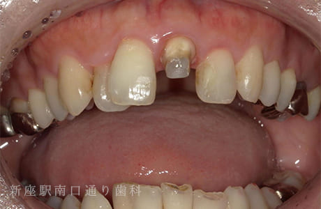 審美障害をジルコニアボンドセラミック術前