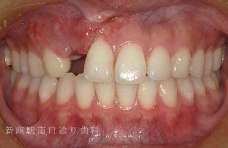 先天的欠損をジルコニア接着ブリッジ術前