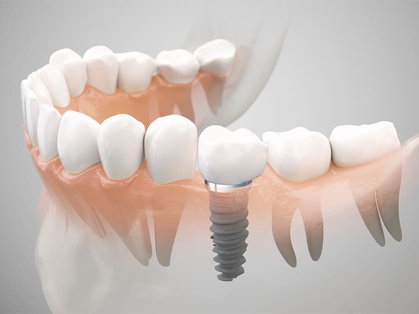 インプラントで、もう一度美しい笑顔に