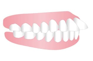 虫出っ歯、上顎前突