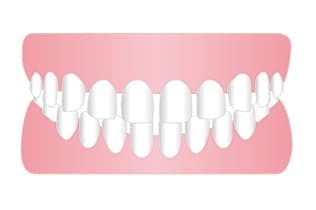 すきっ歯（空隙歯列弓）