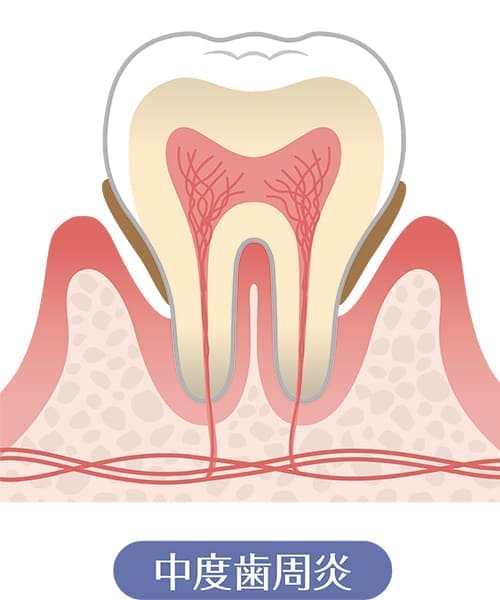 中等度歯周病（口臭、歯が動く、噛むと痛い、膿が出る等）