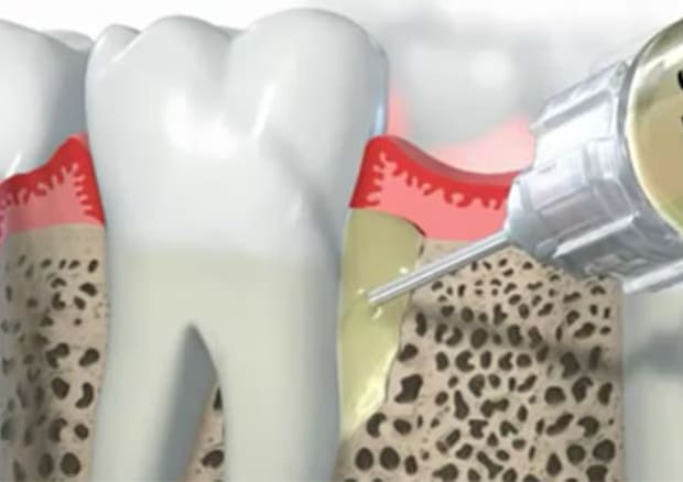 再生療法で、ご自身の歯を救う