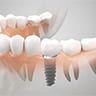 インプラント治療