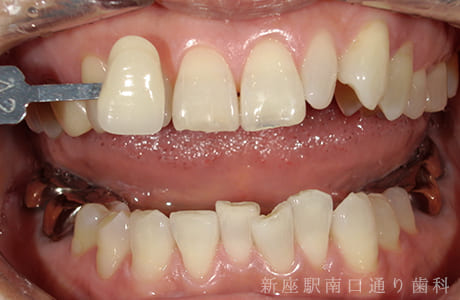 オフィスホワイトニング術後