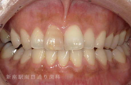 オフィスホワイトニング術前