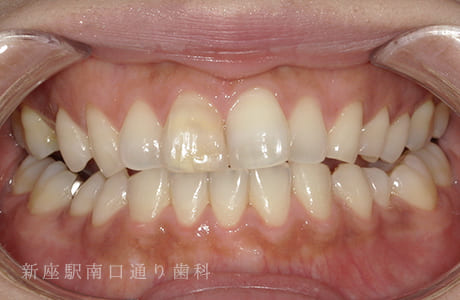 オフィスホワイトニング術後