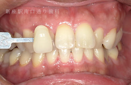 オフィスホワイトニング術後