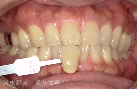 オフィスホワイトニング術前