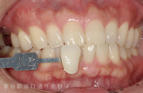 オフィスホワイトニング術後