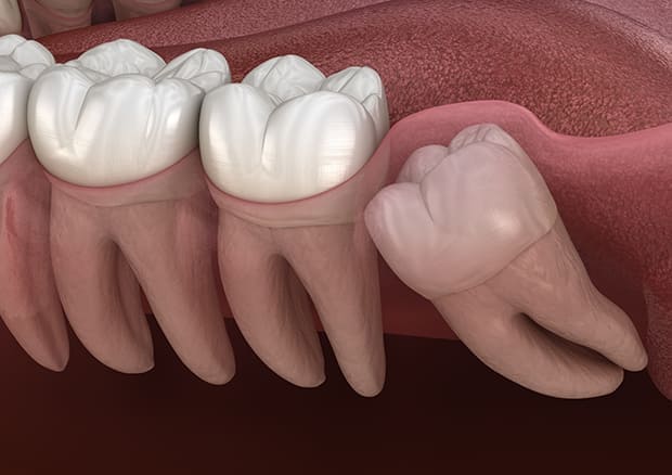 斜めに生えている親知らず